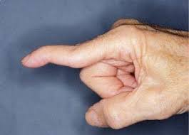 Kuğuboynu (Swan Neck) Deformitesi