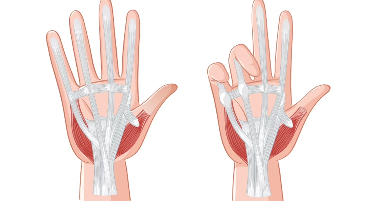 Dupuytren Kontraktürü