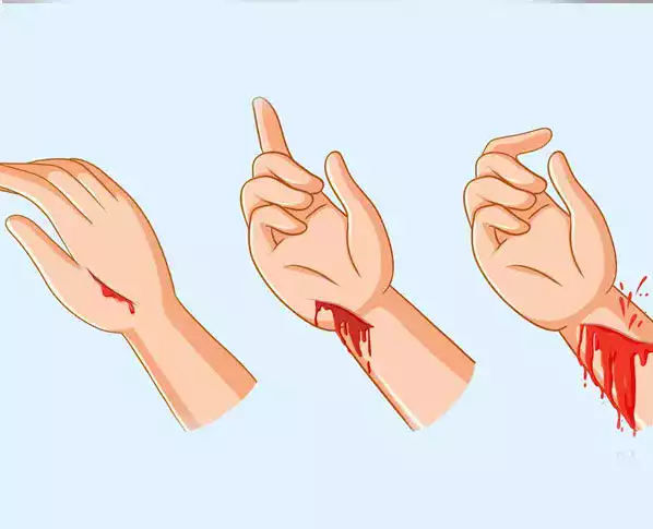 Kesikler ve yara izleri