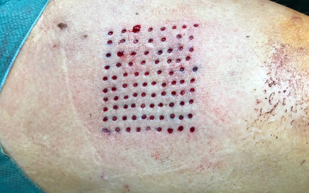 Cilt grefti ve flep cerrahisi