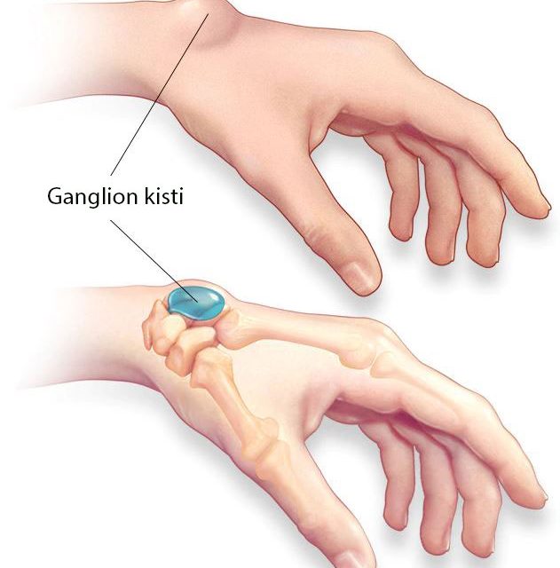 Tümörler ve Kitleler