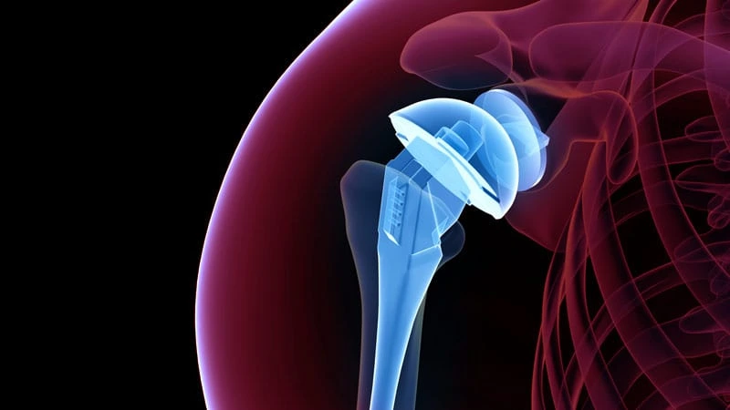 Omuz Protezi (Total Omuz Artroplastisi)