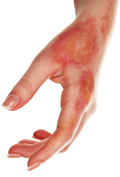 Yanık ve Deri Problemleri